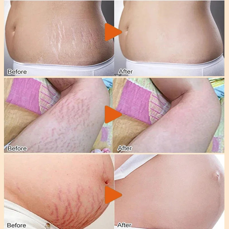 Anti Stretch Marks Body Cream Removal 40g