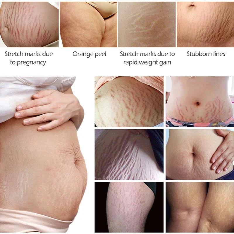 Anti Stretch Marks Body Cream Removal 40g